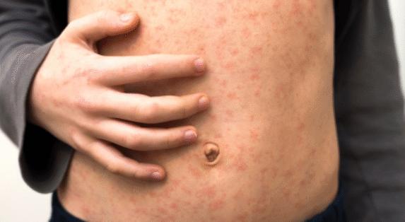 Data shows measles cases remain high with London and the North West driving increase