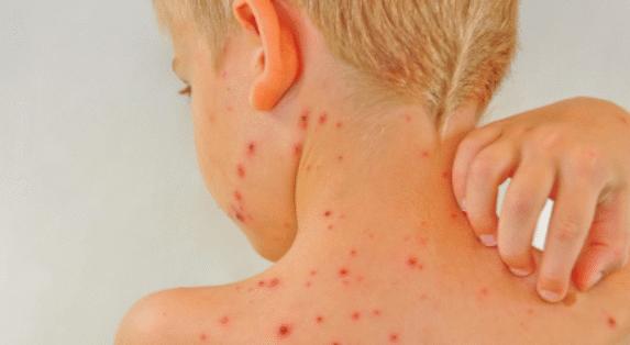 Free chickenpox vaccination offered for the first time to children