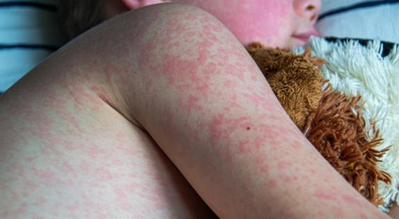 UK loses its measles elimination status
